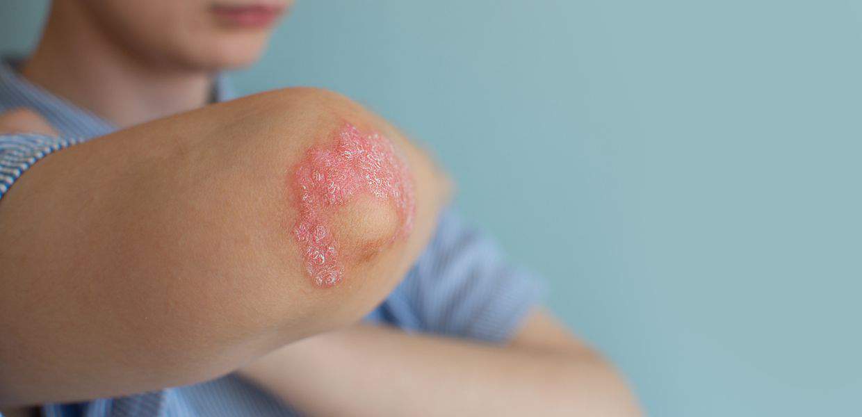 farmaco artrite psoriasica