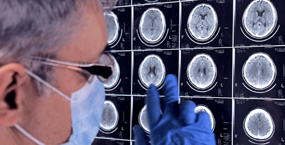 Alzheimer farmaco rallenta declino cognitivo