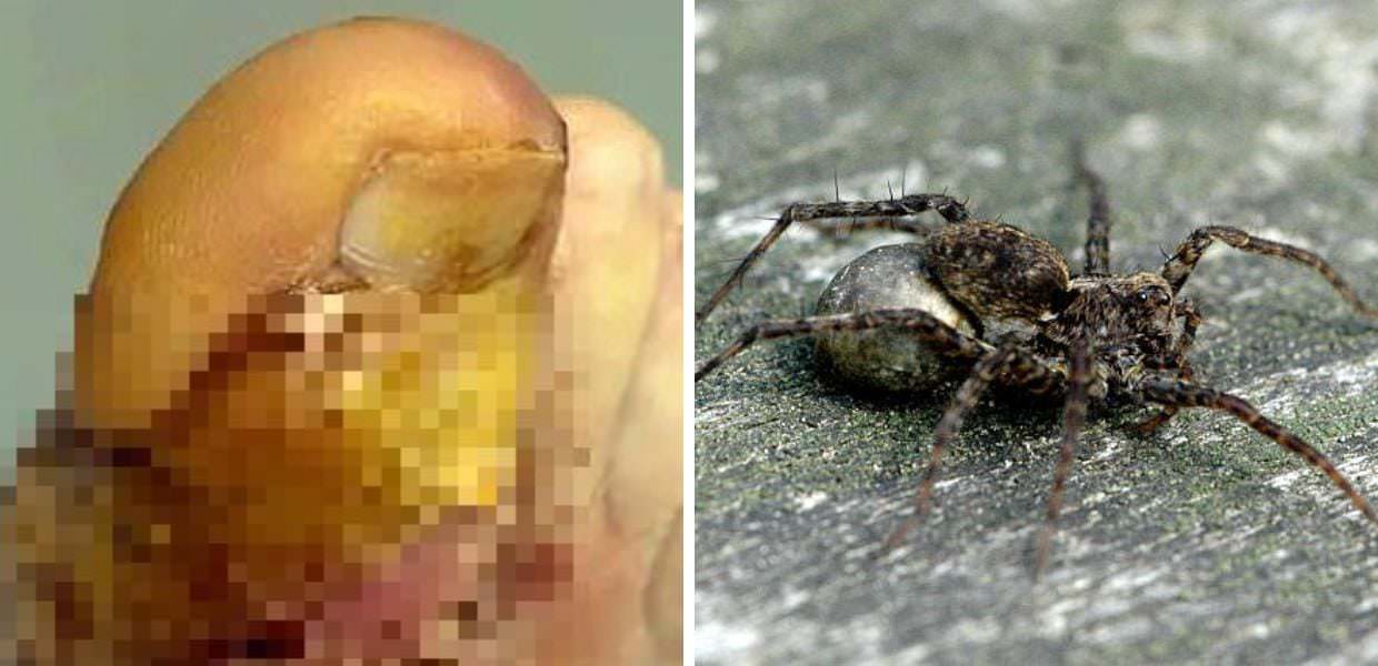 Francia, ragno depone uova nel piede di un uomo