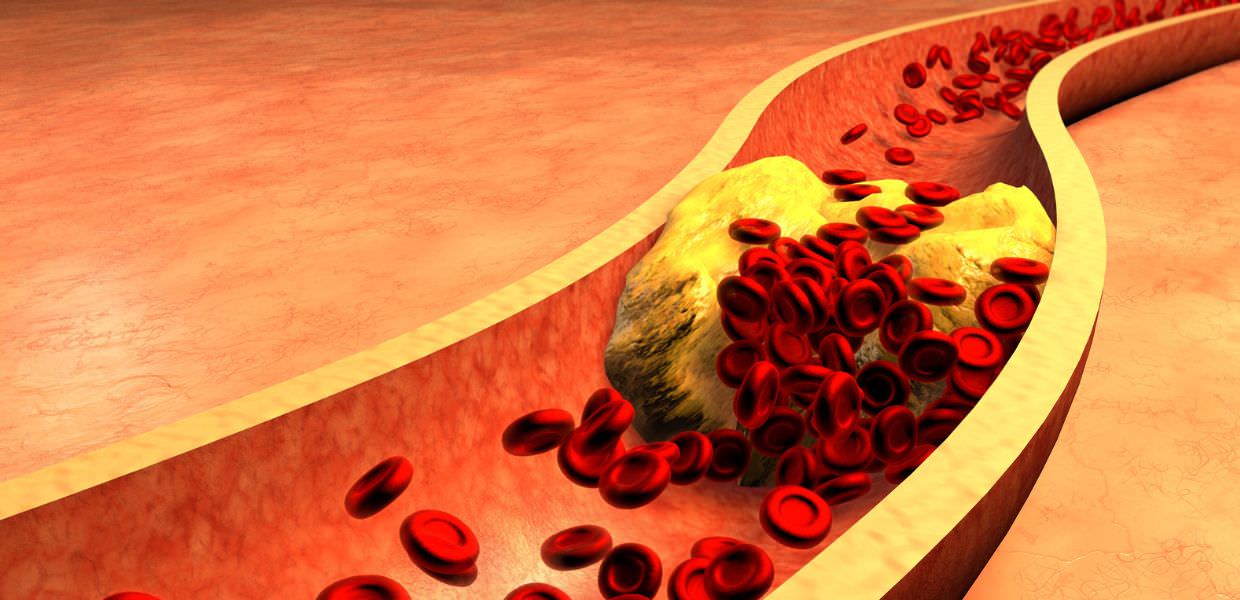 Microplastiche nelle arterie, la scoperta rivoluzionaria prova i danni sulla salute dell'uomo