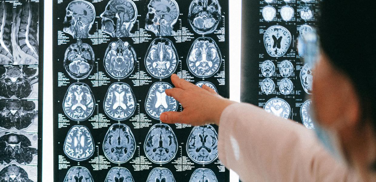 Microplastiche, nel cervello sono sempre di più raddoppiate in 8 anni