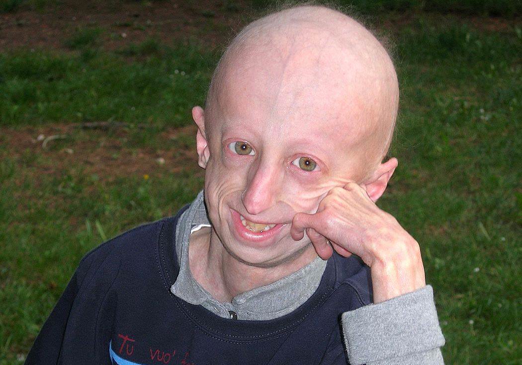 Morto Sammy Basso, il più longevo malato al mondo di progeria