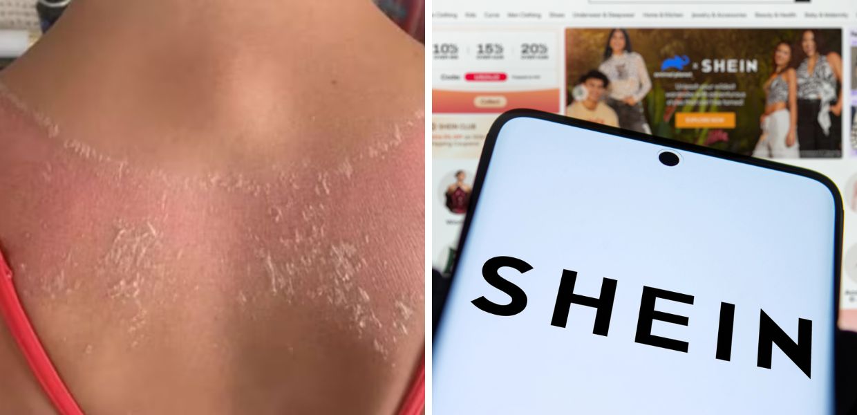 Un top acquistato su Shein causa una grave ustione sulla schiena. La traumatica esperienza di una ragazza  britannica con il noto brand di fast fashion.