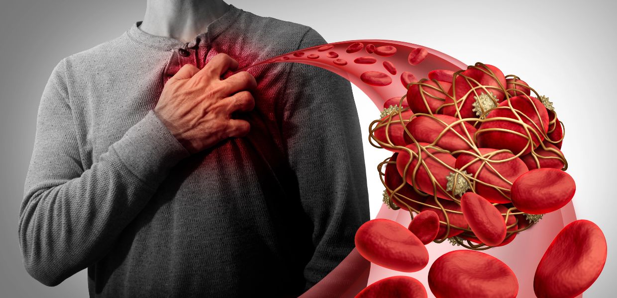 Sanità prevenzione e nuove terapie su infarto, ictus e trombosi, esperti a confronto a Roma